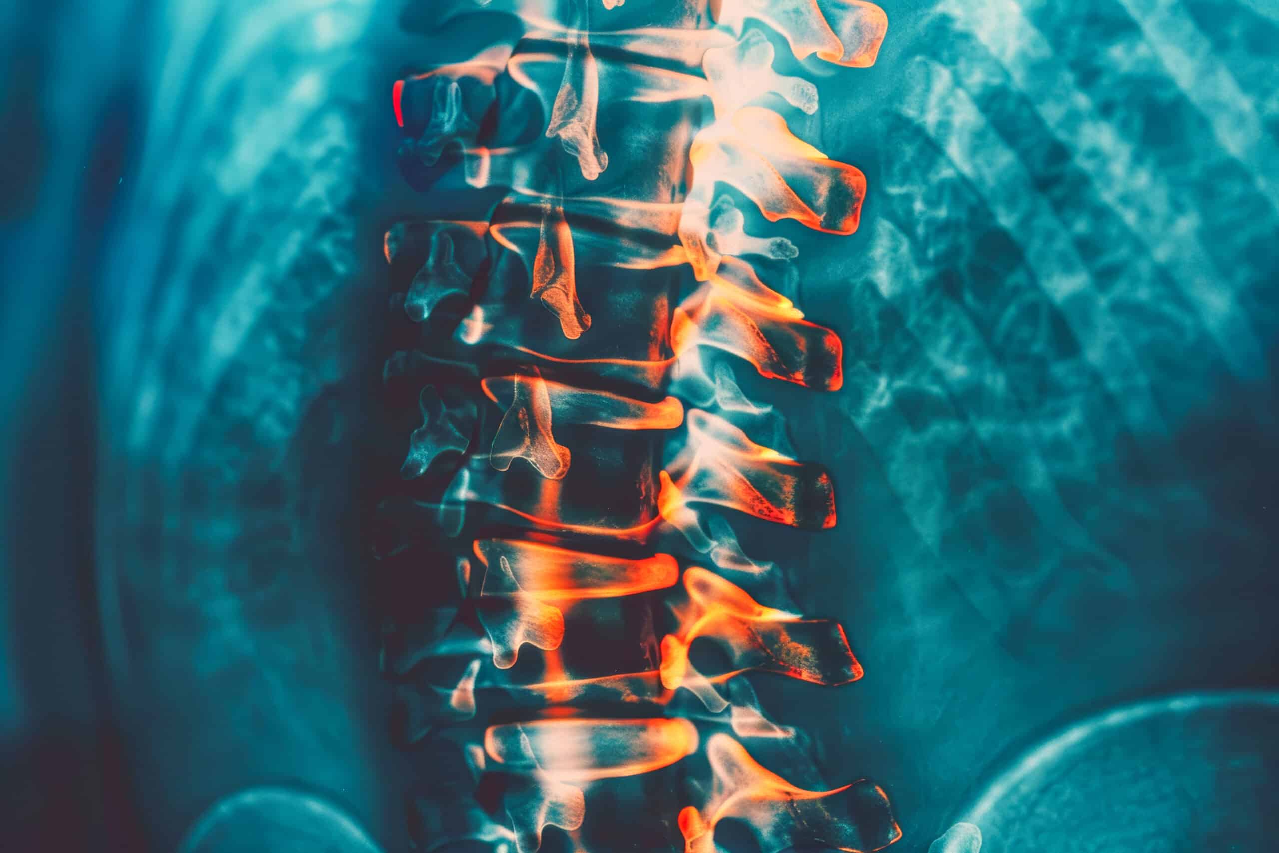 spinal cord injury